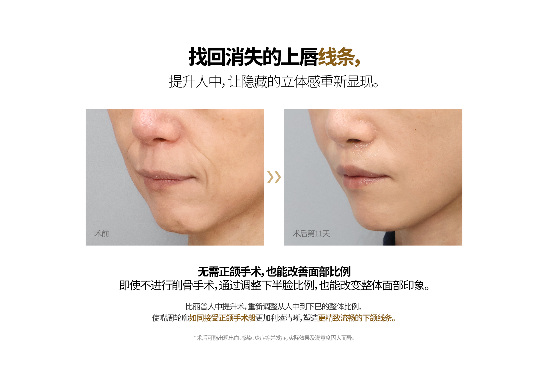 找回消失的上唇线条， 提升人中，让隐藏的立体感重新显现。 无需正颌手术，也能改善面部比例 即使不进行削骨手术，通过调整下半脸比例，也能改变整体面部印象。 比丽普人中提升术，重新调整从人中到下巴的整体比例， 使嘴周轮廓如同接受正颌手术般更加利落清晰，塑造更精致流畅的下颌线条。 ※ 术后可能出现出血、感染、炎症等并发症，实际效果及满意度因人而异。