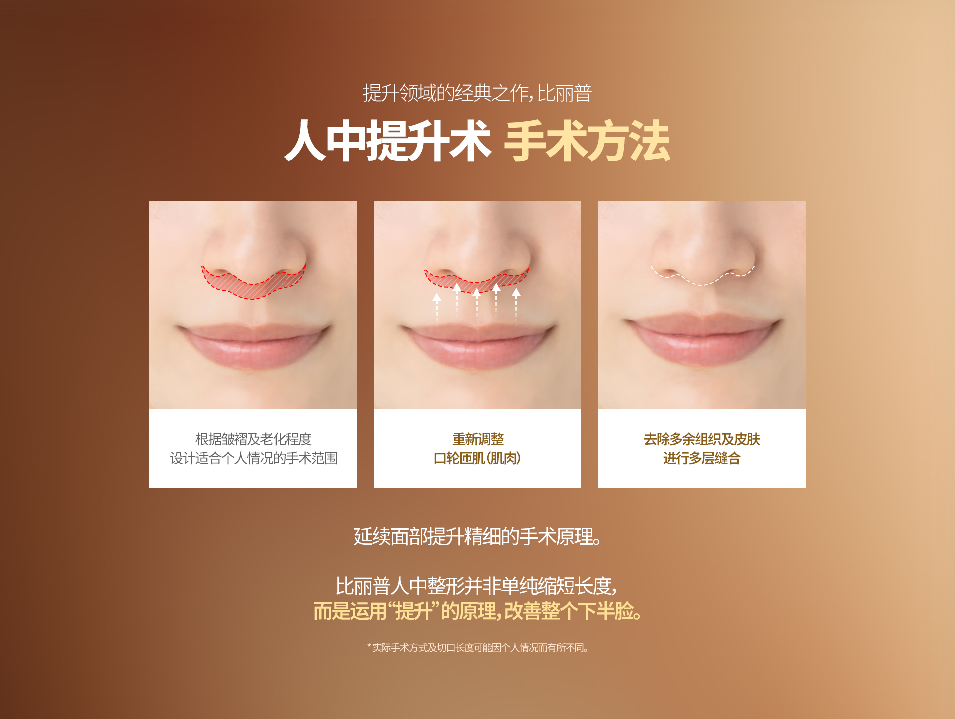 提升领域的经典之作，比丽普 人中提升术 手术方法 根据皱褶及老化程度 设计适合个人情况的手术范围 重新调整 口轮匝肌（肌肉） 去除多余组织及皮肤 进行多层缝合 延续面部提升精细的手术原理。 比丽普人中整形并非单纯缩短长度， 而是运用“提升”的原理，改善整个下半脸。 ※ 实际手术方式及切口长度可能因个人情况而有所不同。