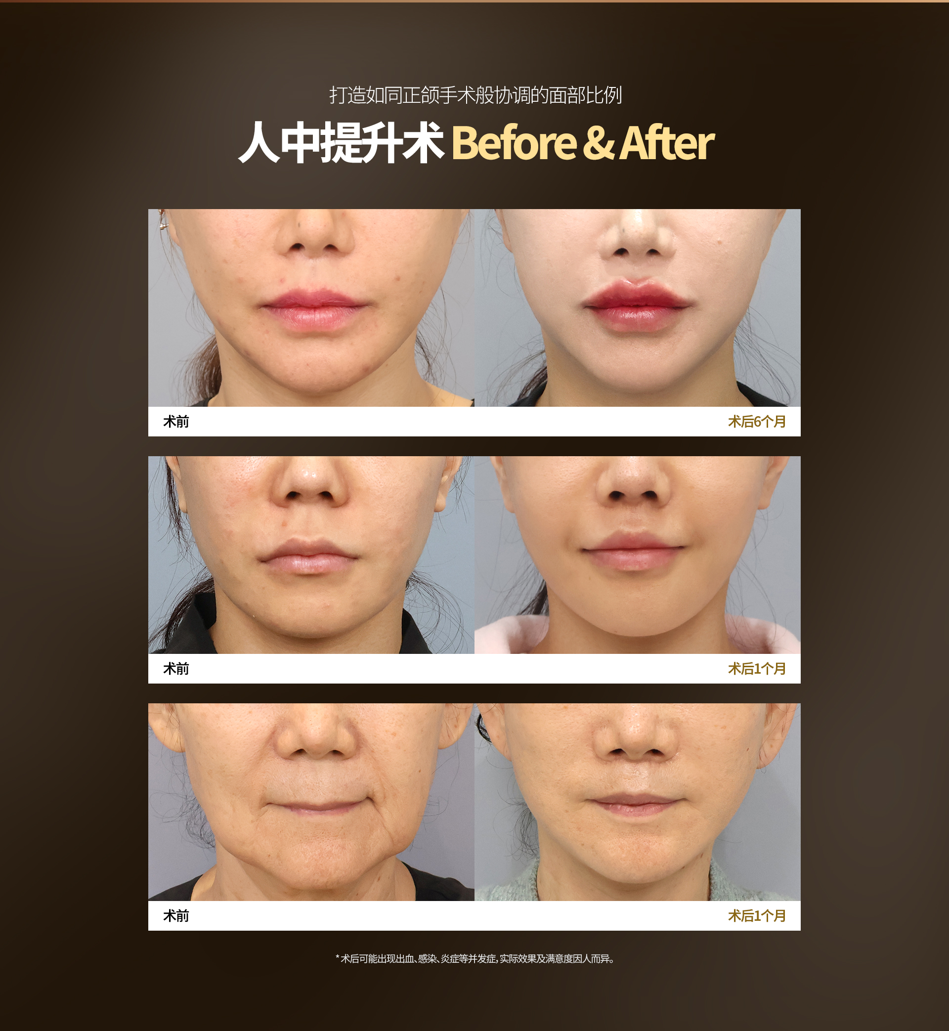 打造如同正颌手术般协调的面部比例 人中提升术 Before & After 术前 术后6个月 术前 术后1个月 術前 术后1个月 ※ 术后可能出现出血、感染、炎症等并发症，实际效果及满意度因人而异。