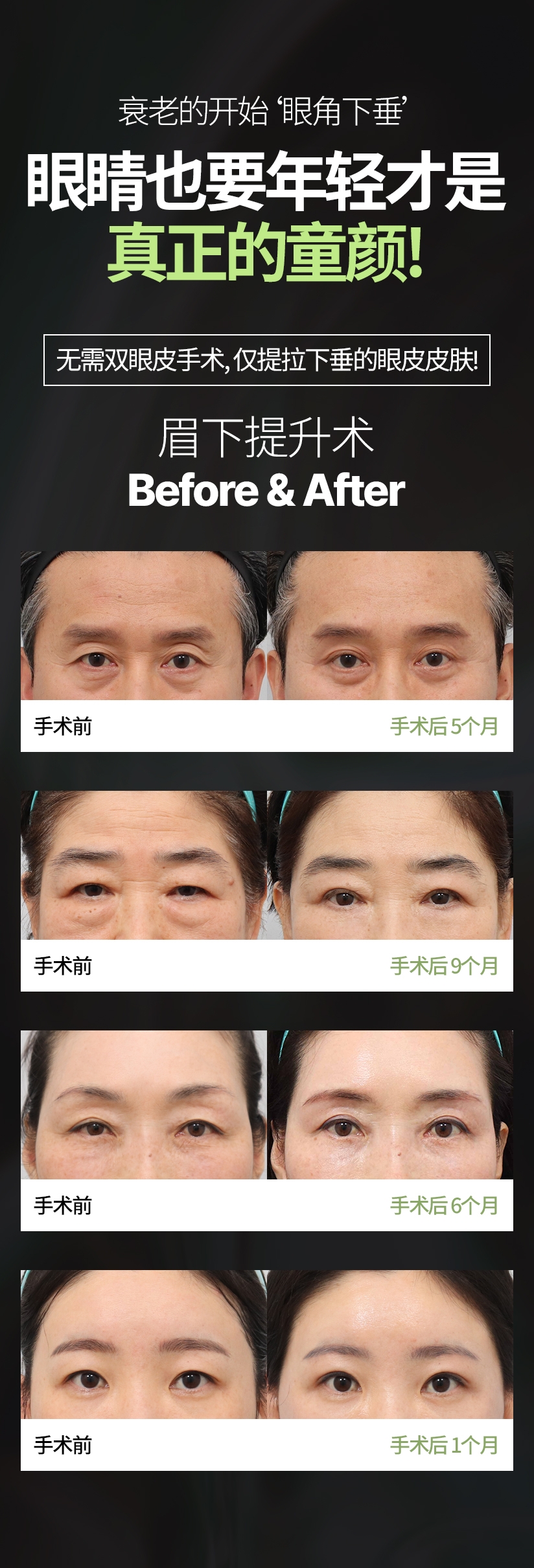 衰老的开始‘眼角下垂’ 眼睛也要年轻才是真正的童颜! 无需双眼皮手术, 仅提拉下垂的眼皮皮肤! 眉下提升术 Before & After