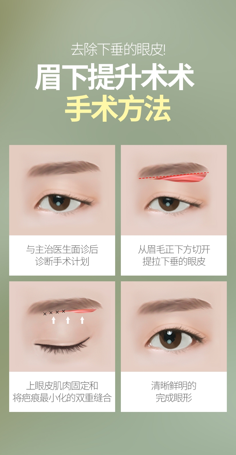 去除下垂的眼皮! 眉下提升术术 手术方法 与主治医生面诊后 诊断手术计划 从眉毛正下方切开 提拉下垂的眼皮 上眼皮肌肉固定和 将疤痕最小化的双重缝合 清晰鲜明的 完成眼形