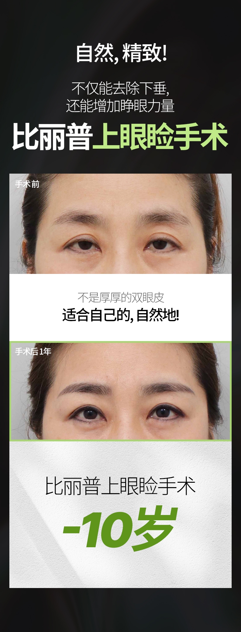 自然, 精致! 不仅能去除下垂, 还能增加睁眼力量 比丽普 上眼睑手术 不是厚厚的双眼皮 适合自己的, 自然地! 比丽普上眼睑手术 -10岁 