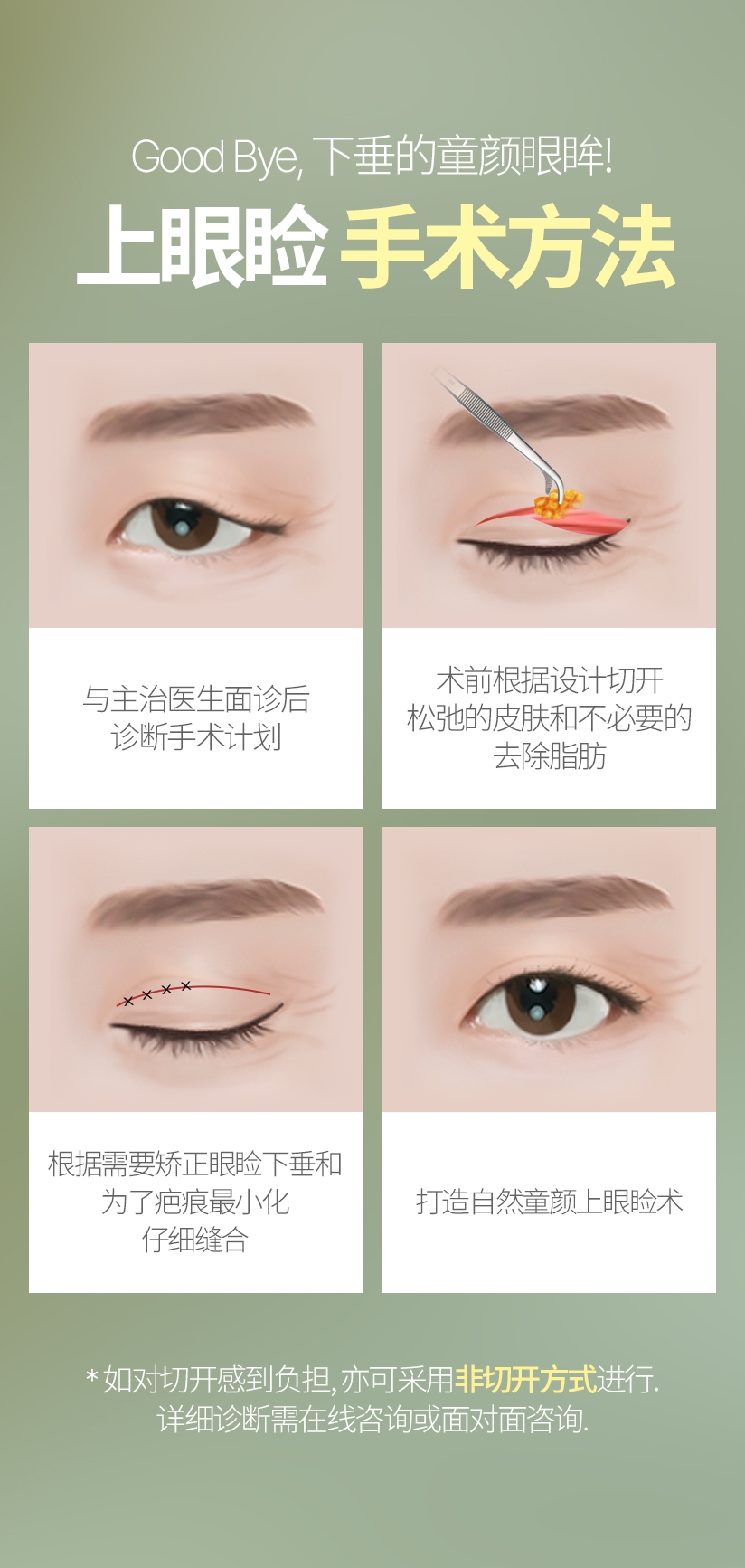 Good Bye, 下垂的童颜眼眸! 上眼睑 手术方法 与主治医生面诊后 诊断手术计划 术前根据设计切开 松弛的皮肤和不必要的 去除脂肪 根据需要矫正眼睑下垂和 为了疤痕最小化 仔细缝合 根据需要矫正眼睑下垂和 为了疤痕最小化 仔细缝合 * 如对切开感到负担，亦可采用非切开方式进行. 详细诊断需在线咨询或面对面咨询. 