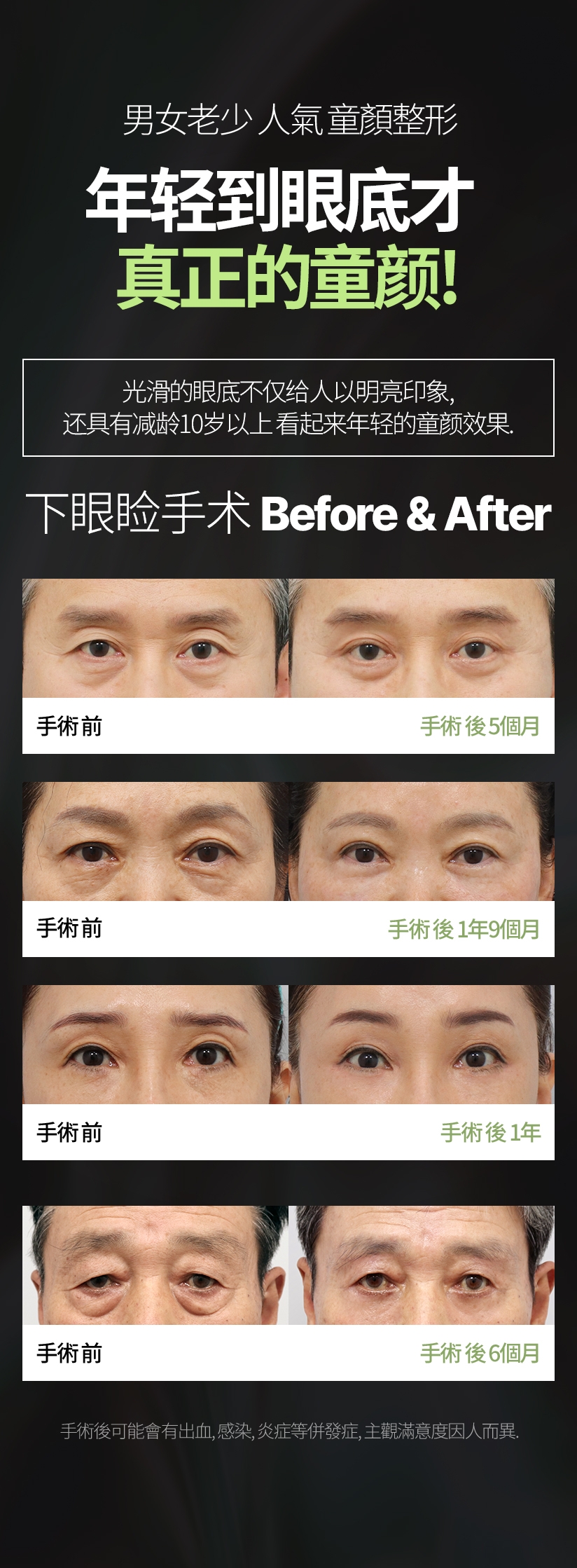 男女老少 人气 童颜整形 年轻到眼底才是真正的童颜! 光滑的眼底不仅给人以明亮印象, 还具有减龄10岁以上 看起来年轻的童颜效果. 下眼睑手术 Before & After 手术后可能会有出血, 感染, 炎症等并发症, 主观满意度因人而异.