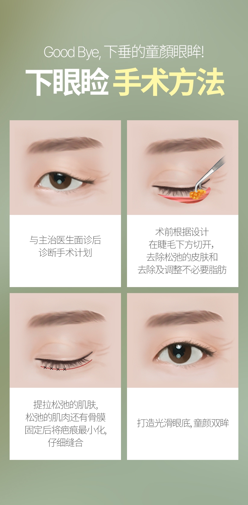 Good Bye, 下垂的童颜眼眸! 下眼睑 手术方法 与主治医生面诊后 诊断手术计划 术前根据设计 在睫毛下方切开， 去除松弛的皮肤和 去除及调整不必要脂肪 提拉松弛的肌肤, 松弛的肌肉还有骨膜 固定后将疤痕最小化, 仔细缝合 打造光滑眼底, 童颜双眸