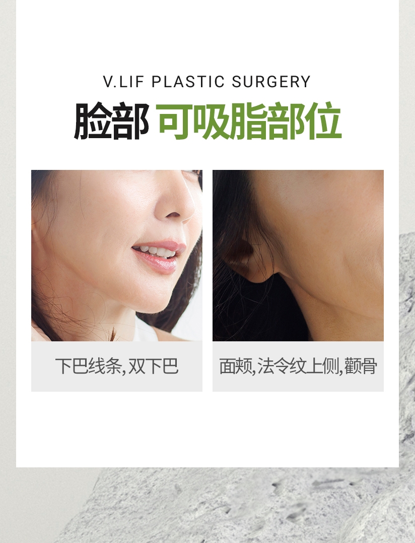 脸部可吸脂部位 下巴线条, 双下巴 面颊, 法令纹上侧, 颧骨