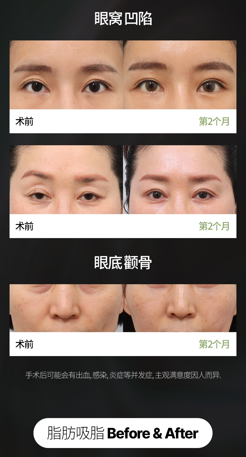 脂肪填充术 Before & After 眼窝 凹陷 手术后可能会有出血, 感染, 炎症等并发症, 主观满意度因人而异.