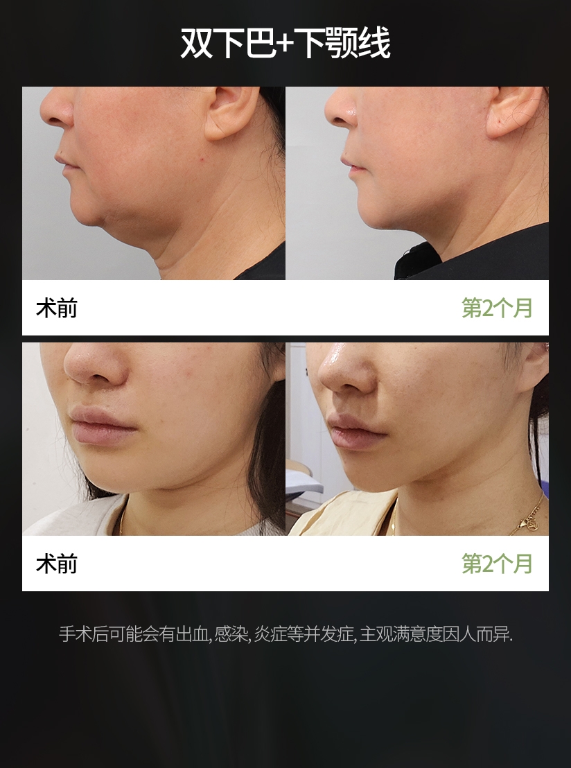 脂肪吸脂 Before & After  双下巴+下颚线 手术后可能会有出血, 感染, 炎症等并发症, 主观满意度因人而异. 