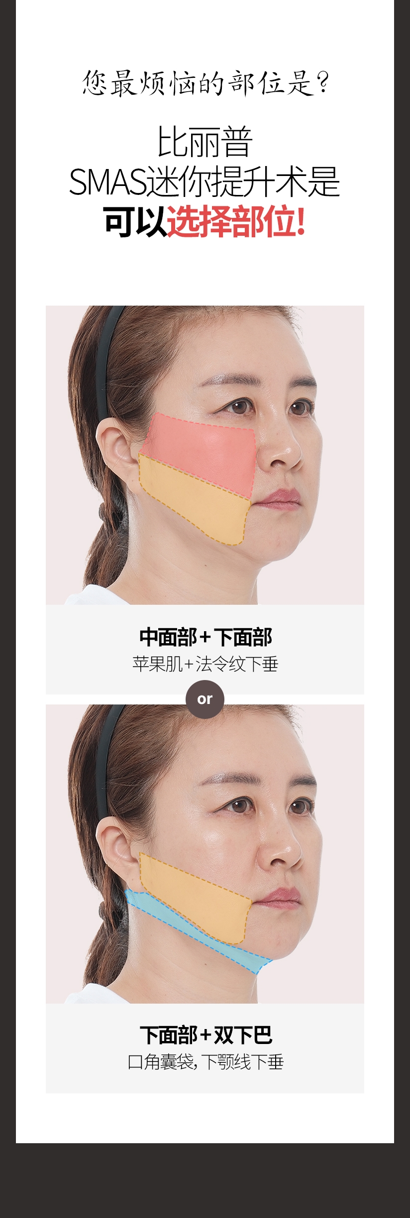 您最烦恼的部位是? 比丽普 SMAS迷你提升术是 可以选择部位! 中面部 + 下面部 苹果肌 + 法令纹下垂 下面部 + 双下巴 口角囊袋，下颚线下垂 