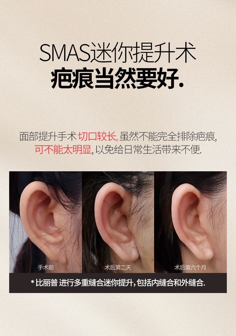 SMAS迷你提升术 疤痕当然要好. 面部提升手术 切口较长, 虽然不能完全排除疤痕, 可不能太明显, 以免给日常生活带来不便. 手术前 术后第二天 术后第六个月 * 比丽普 进行多重缝合迷你提升，包括内缝合和外缝合. 