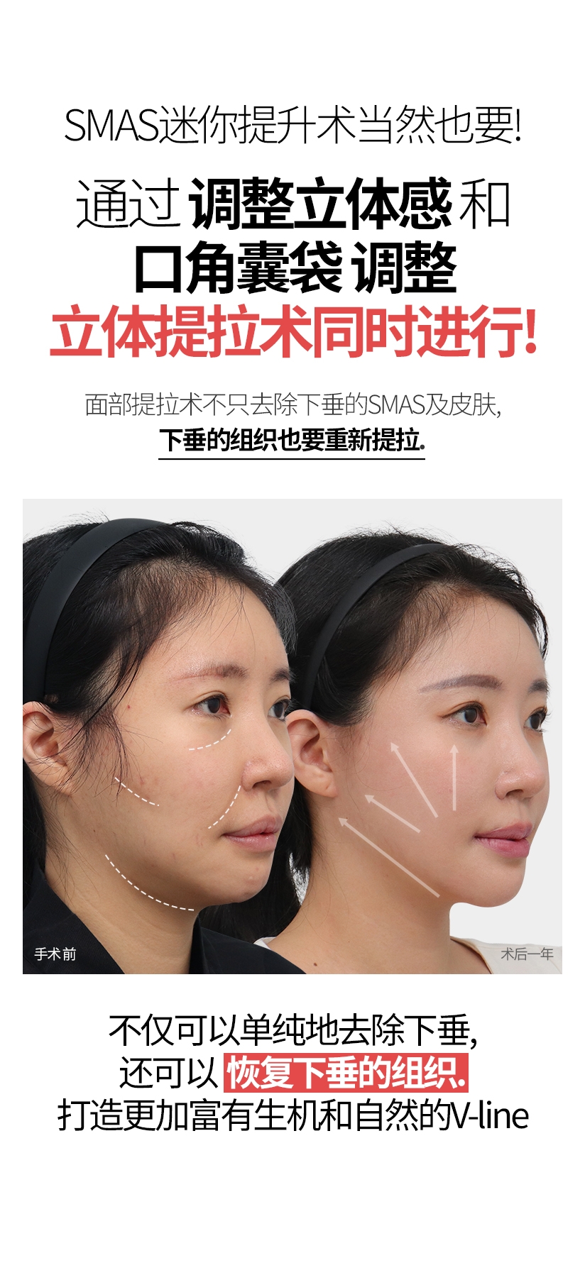 SMAS迷你提升术当然也要! 通过 调整立体感 和 口角囊袋 调整  立体提拉术同时进行! 面部提拉术不只去除下垂的SMAS及皮肤, 下垂的组织也要重新提拉. 手术 前 术后一年 不仅可以单纯地去除下垂，还可以 恢复下垂的组织. 打造更加富有生机和自然的V-line.