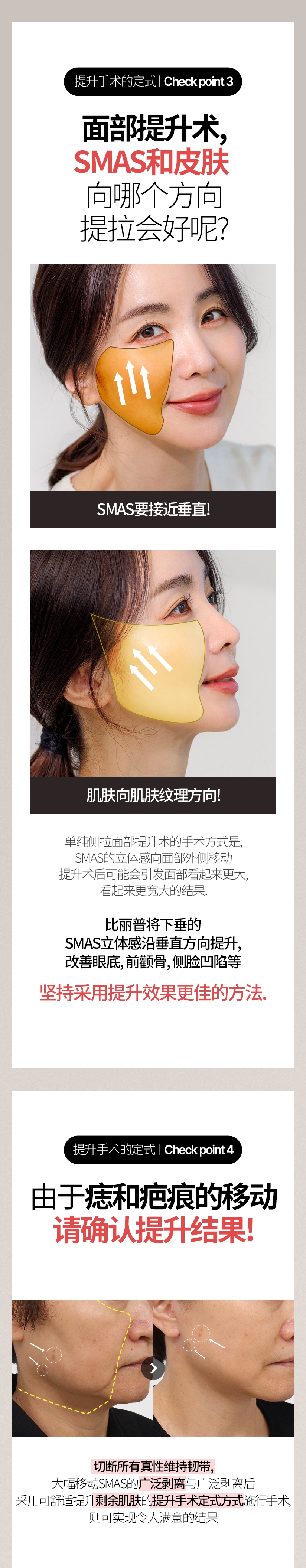 提升手术的定式  |  Check point 3 面部提升术, SMAS和皮肤 向哪个方向 提拉会好呢? SMAS要接近垂直! 肌肤向肌肤纹理方向! 单纯侧拉面部提升术的手术方式是, SMAS的立体感向面部外侧移动 提升术后可能会引发面部看起来更大, 看起来更宽大的结果. 比丽普将下垂的SMAS立体感沿垂直方向提升, 改善眼底, 前颧骨, 侧脸凹陷等 坚持采用提升效果更佳的方法. 提升手术的定式  |  Check point 4 由于 痣和疤痕的移动, 请确认提升结果! 切断所有真性维持韧带, 大幅移动SMAS的广泛剥离与广泛剥离后 采用可舒适提升剩余肌肤的提升手术定式方式施行手术, 则可实现令人满意的结果