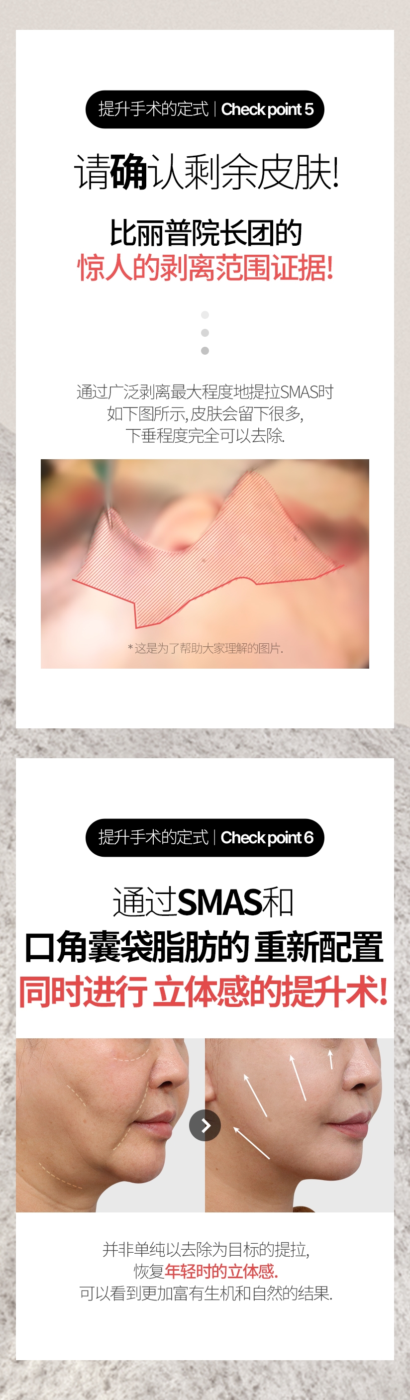 提升手术的定式  |  Check point 5 请确认剩余皮肤. 比丽普院长团的 惊人的剥离范围证据! 通过广泛剥离最大程度地提拉SMAS时 如下图所示, 皮肤会留下很多, 下垂程度完全可以去除. * 这是为了帮助大家理解的图片. 提升手术的定式  |  Check point 6 通过SMAS和口角囊袋脂肪的重新配置 同时进行 立体感的提升术! 并非单纯以去除为目标的提拉, 恢复 年轻时的立体感. 可以看到更加富有生机和自然的结果.