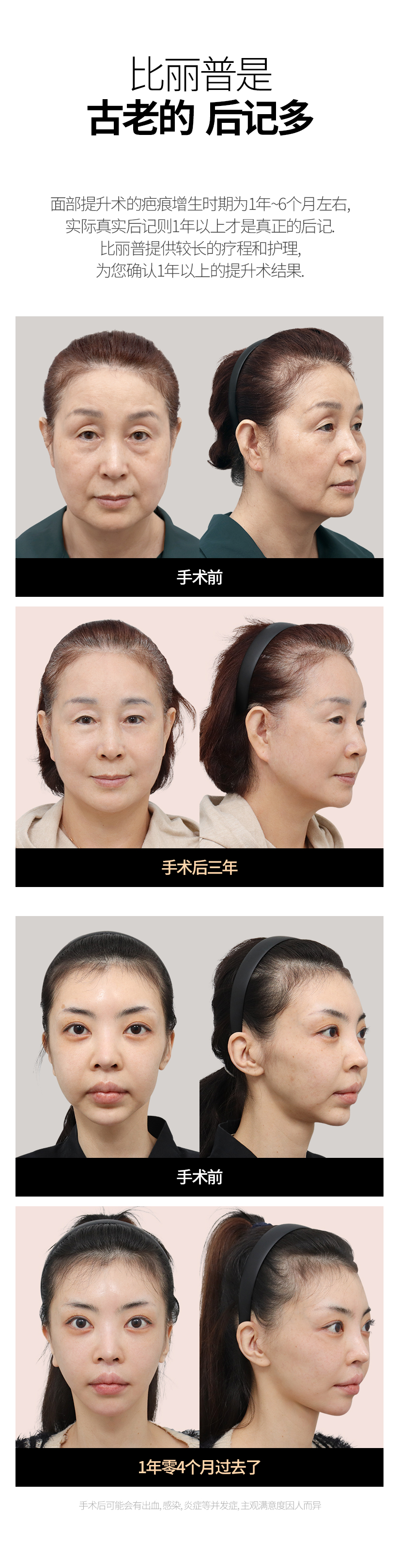 比丽普是 古老的  后记多 面部提升术的疤痕增生时期为1年~6个月左右, 实际真实后记则1年以上才是真正的后记. 比丽普提供较长的疗程和护理, 为您确认1年以上的提升术结果. 手术前 手术后三年 手术前 1年零4个月过去了 手术后可能会有出血, 感染, 炎症等并发症, 主观满意度因人而异