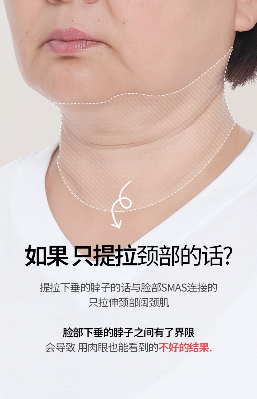 如果 只提拉 颈部的话? 提拉下垂的脖子的话 与脸部SMAS连接的 只拉伸颈部阔颈肌 脸部下垂的脖子之间有了界限 会导致 用肉眼也能看到的 不好的结果.