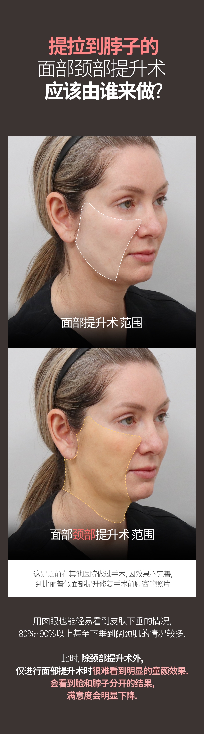 提拉到脖子的 面部颈部提升术 应该由谁来做? 面部提升术 范围 面部颈部提升术 范围 用肉眼也能轻易看到皮肤下垂的情况、80%~90%以上甚至下垂到阔颈肌的情况较多. 此时, 除颈部提升术外, 仅进行面部提升术时 很难看到明显的童颜效果. 会看到脸和脖子分开的结果, 满意度会明显下降  .