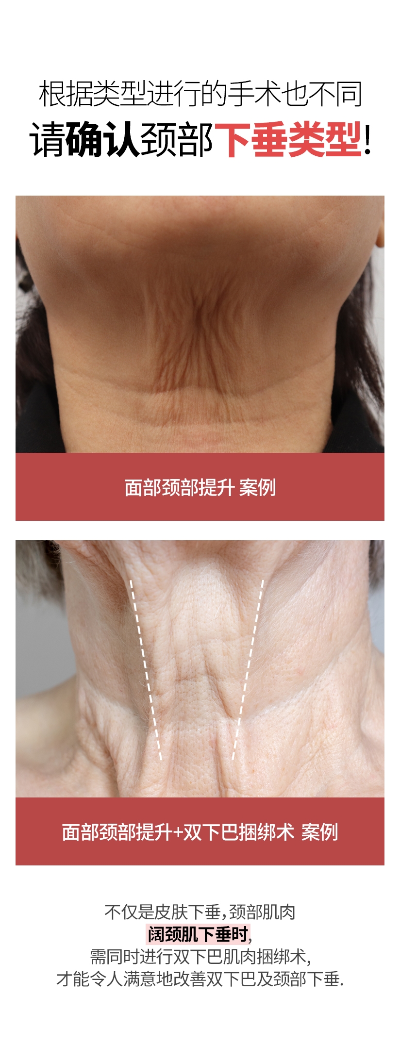 根据类型进行的手术也不同 请确认颈部下垂类型! 面部颈部提升 案例 面部颈部提升+双下巴捆绑术  案例 不仅是皮肤下垂, 颈部肌肉阔颈肌下垂时, 需同时进行双下巴肌肉捆绑术, 才能令人满意地改善双下巴及颈部下垂.