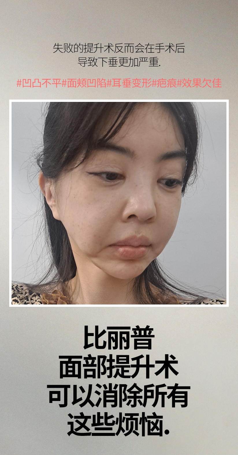 失败的提升术反而会在手术后 导致下垂更加严重 #凹凸不平#面颊凹陷#耳垂变形#疤痕#效果欠佳  比丽普 面部提升术 可以消除所有 这些烦恼.