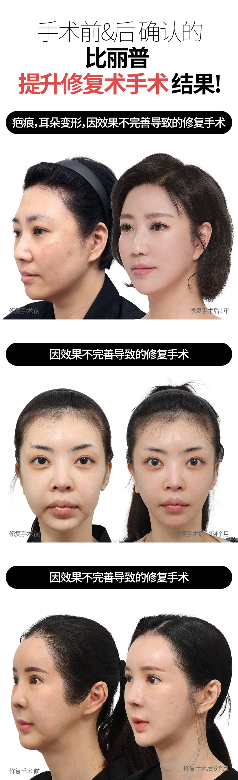 手术前&后 确认的 比丽普 提升修复术手术 结果! 疤痕, 耳朵变形, 因效果不完善导致的修复手术 修复手术 前 修复手术后 1年 因效果不完善导致的修复手术 修复手术 前 修复手术后 1年4个月 因效果不完善导致的修复手术 修复手术 前 修复手术后 6个月