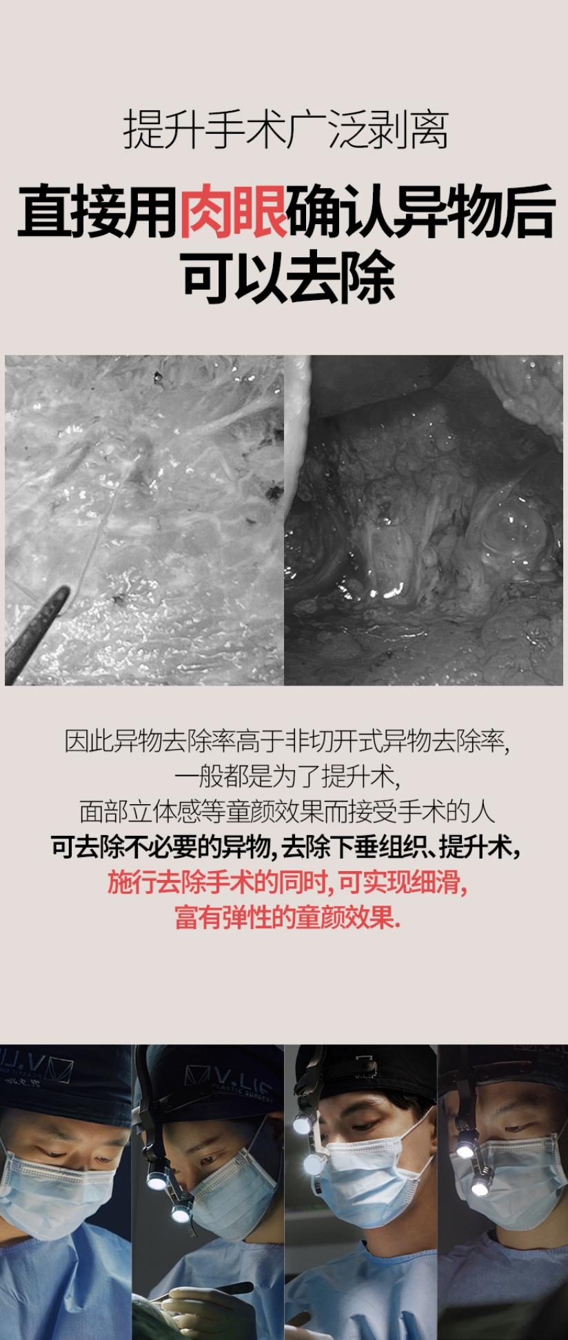 提升手术广泛剥离 直接用肉眼确认异物后 可以去除 因此异物去除率高于非切开式异物去除率, 一般都是为了提升术, 面部立体感等童颜效果而接受手术的人 可去除不必要的异物, 去除下垂组织, 提升术, 施行去除手术的同时, 可实现细滑, 富有弹性的童颜效果.
