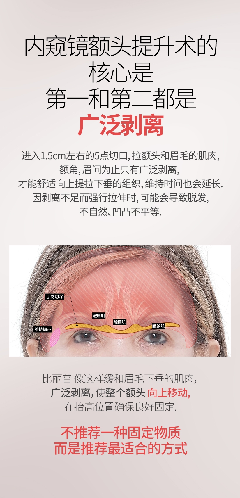 内窥镜额头提升术的核心是 第一和第二都是广泛剥离 进入1.5cm左右的5点切口, 拉额头和眉毛的肌肉, 额角, 眉间为止 只有广泛剥离, 才能舒适向上提拉下垂的组织, 维持时间也会延长. 因剥离不足而强行拉伸时, 可能会导致脱发, 不自然, 凹凸不平等. 比丽普 像这样缓和眉毛下垂的肌肉，广泛剥离，使整个额头向上移动, 在抬高位置确保良好固定 不推荐一种固定物质 而是推荐最适合的方式