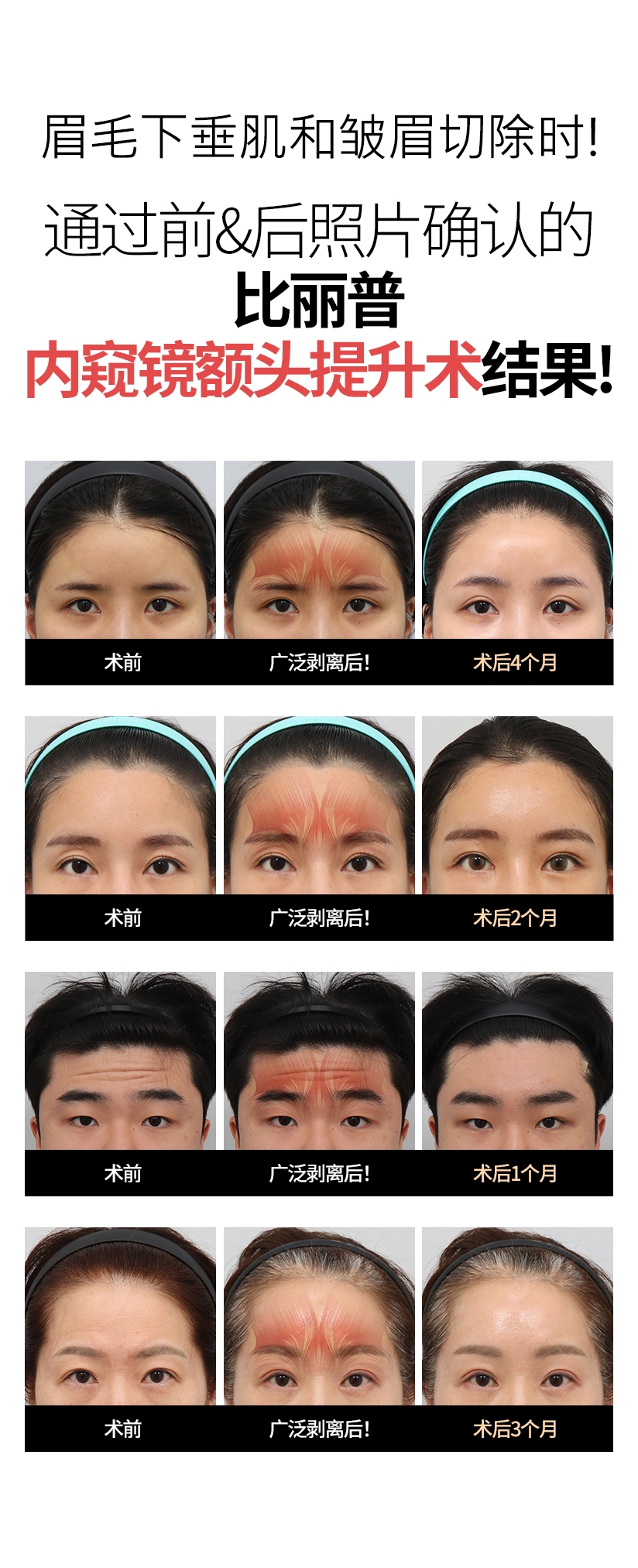 眉毛下垂肌和皱眉切除时! 通过前&后照片确认的 比丽普内窥镜额头提升术 结果! 术前 广泛剥离后! 术后4个月 术前 广泛剥离后! 术后2个月 术前 广泛剥离后! 术后1个月 術前 广泛剥离后! 术后3个月