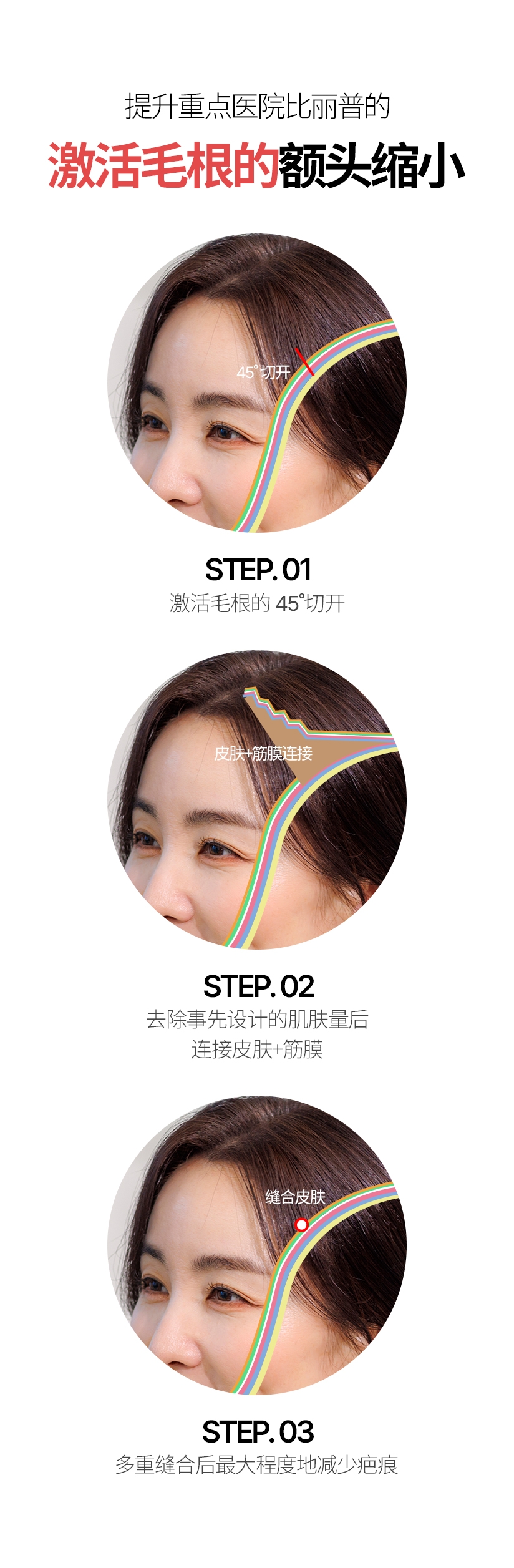 提升重点医院比丽普的 激活毛根的额头缩小 45˚ 切开 皮肤+筋膜连接 缝合皮肤 STEP. 01 激活毛根的45切开 STEP. 02 去除事先设计的肌肤量后 连接皮肤+筋膜 STEP. 03 多重缝合后最大程度地减少疤痕