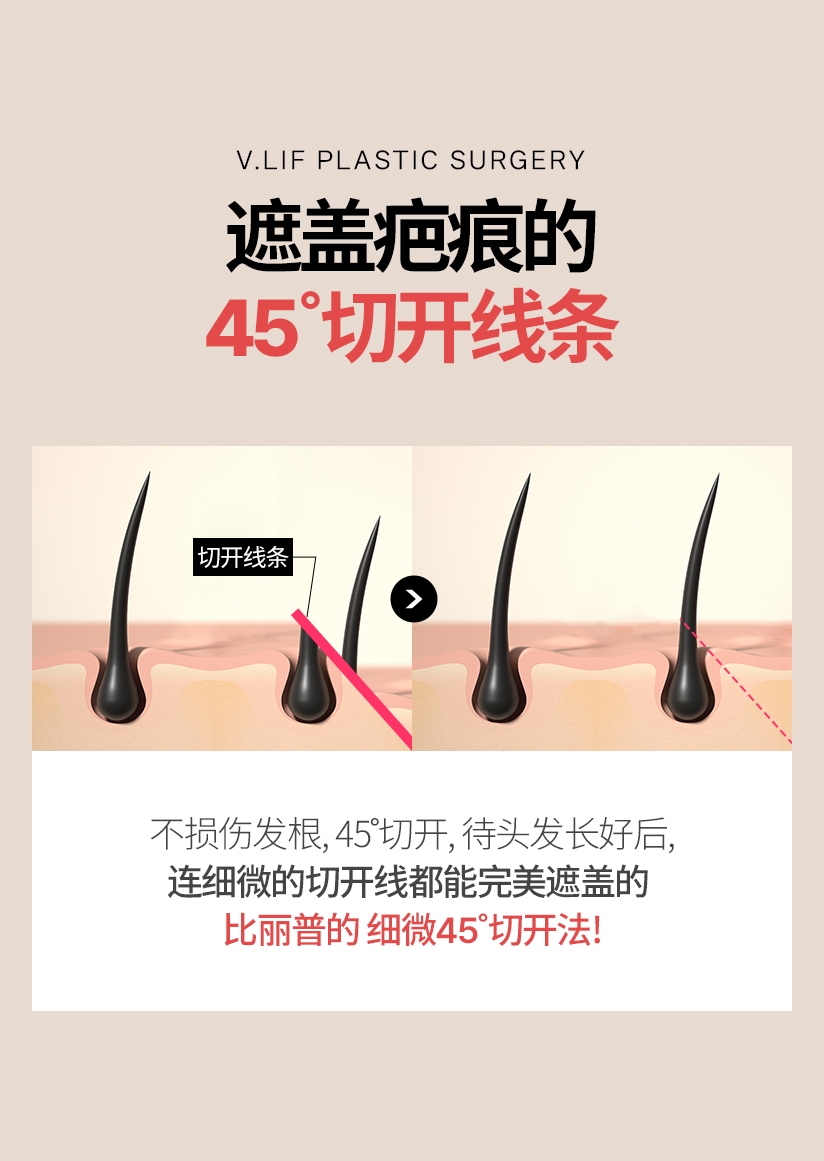 遮盖疤痕的 45˚切开线条 切开线条 不损伤发根, 45˚切开, 待头发长好后, 连细微的切开线都能完美遮盖的比丽普的 细微 45˚切开法
