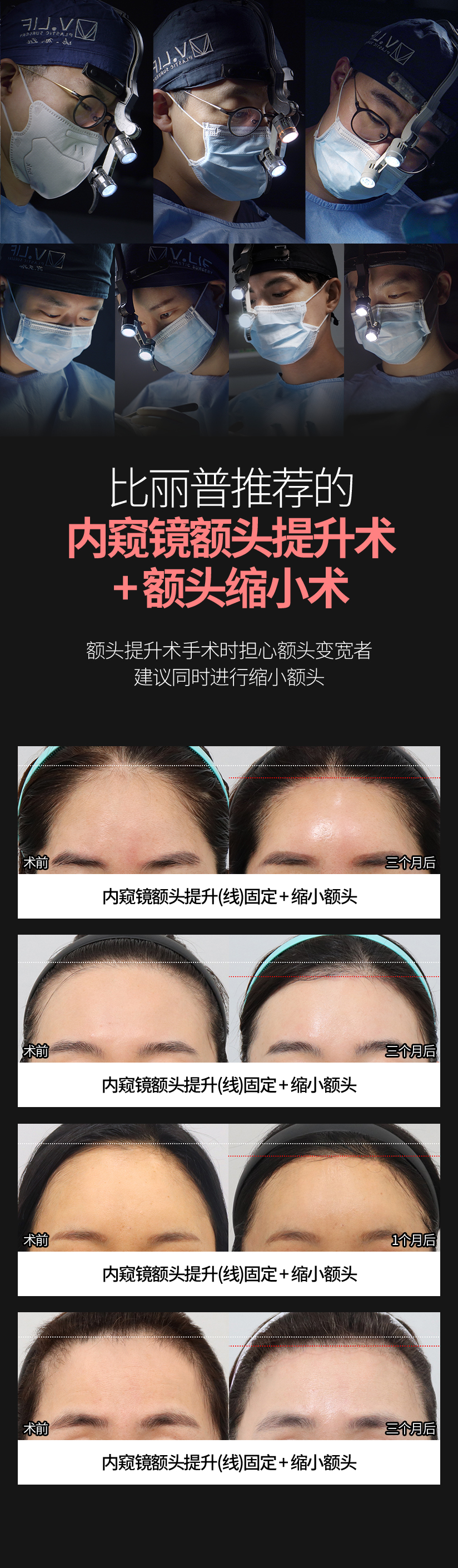 比丽普推荐的 内窥镜额头提升术 + 额头缩小术 额头提升术手术时担心额头变宽者 建议同时进行缩小额头 术前 内窥镜额头提升(线)固定 + 缩小额头 三个月后 术前 内窥镜额头提升(线)固定 + 缩小额头 三个月后 术前 内窥镜额头提升(线)固定 + 缩小额头 1个月后 术前 内窥镜额头提升(线)固定 + 缩小额头 三个月后