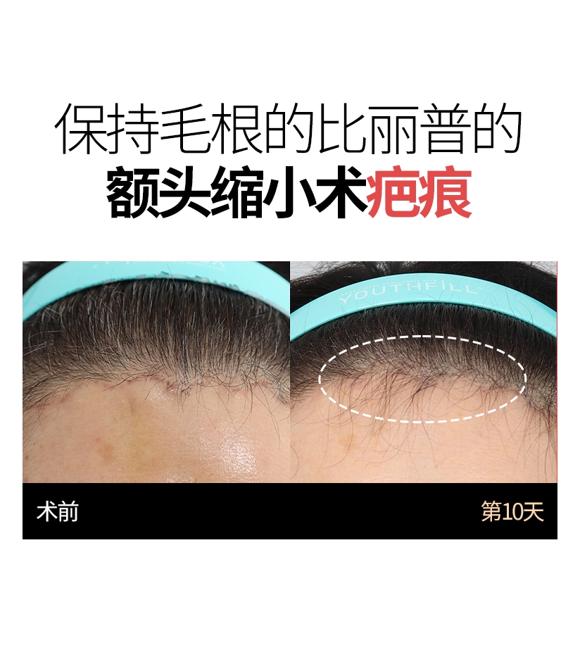 保持毛根的比丽普的 额头缩小术疤痕 术前  第10天 