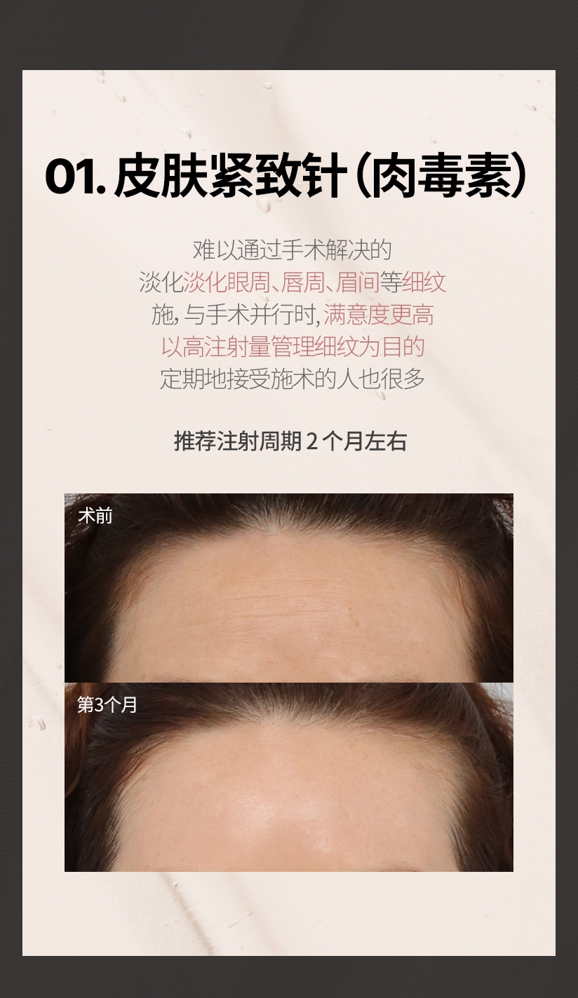 01. 皮肤紧致针（肉毒素） 难以通过手术解决的 淡化淡化眼周, 唇周, 眉间等细纹 施, 与手术并行时, 满意度更高 以高注射量管理细纹为目的 定期地接受施术的人也很多 推荐注射周期 2 个月左右 
