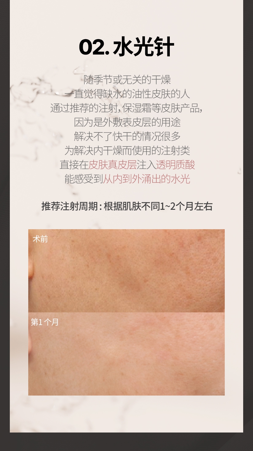 02. 水光针 随季节或无关的干燥 一直觉得缺水的油性皮肤的人 通过推荐的注射，保湿霜等皮肤产品， 因为是外敷表皮层的用途 解决不了快干的情况很多 为解决内干燥而使用的注射类 直接在皮肤真皮层注入透明质酸, 能感受到从内到外涌出的水光 推荐注射周期 : 根据肌肤不同1~2个月左右 