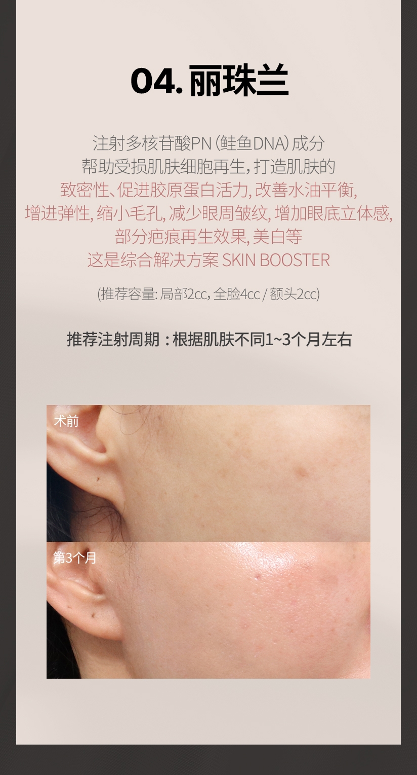 04. 丽珠兰 注射多核苷酸PN（鲑鱼DNA）成分 帮助受损肌肤细胞再生, 打造肌肤的 致密性, 促进胶原蛋白活力, 改善水油平衡, 增进弹性, 缩小毛孔, 减少眼周皱纹, 增加眼底立体感, 部分疤痕再生效果, 美白等 这是综合解决方案 SKIN BOOSTER (推荐容量 : 局部2cc, 全脸4cc / 额头2cc) 推荐注射周期 : 根据肌肤不同1~3个月左右 
