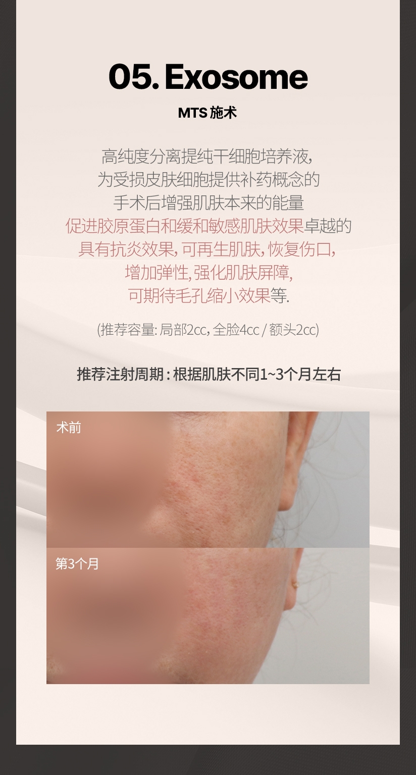 05. Exosome MTS 施术 高纯度分离提纯干细胞培养液， 为受损皮肤细胞提供补药概念的 手术后增强肌肤本来的能量 促进胶原蛋白和缓和敏感肌肤效果卓越的 具有抗炎效果，可再生肌肤，恢复伤口， 增加弹性、强化肌肤屏障、 可期待毛孔缩小效果等. (推荐容量 : 局部2cc, 全脸4cc / 额头2cc) 推荐注射周期 : 根据肌肤不同1~3个月左右 