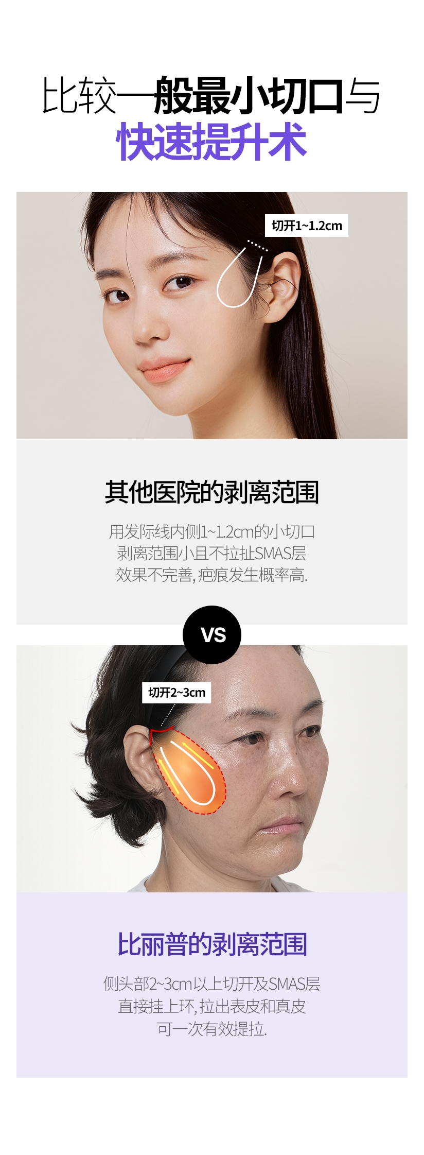 일반 최소절개와 퀵프팅 비교 타 병원의 박리범위 - 헤어라인 안쪽  1~1.2CM 의 작은 절개로 박리 범위가 작고 스마스층을 당기지 않아 효과가 미비하며 흉터 발생 확률이 높습니다. 빌리프의 박리범위 측두부 2~3cm 이상 절개 및 스마스층에 직접 루프를 걸어 표피, 진피 모두 당겨주므로 한번에 효과적인 리프팅이 가능합니다. 