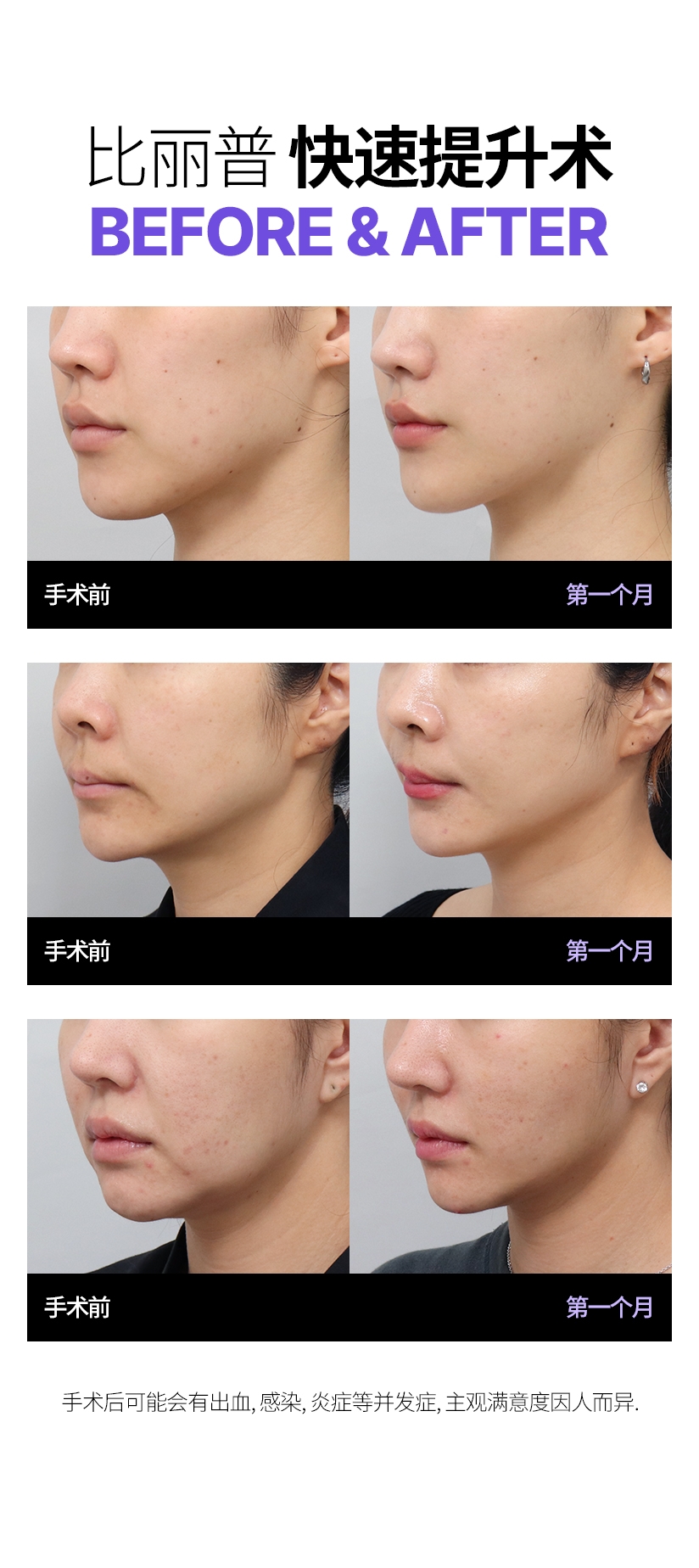 빌리프 퀵프팅 Before & After 수술전 - 1달차