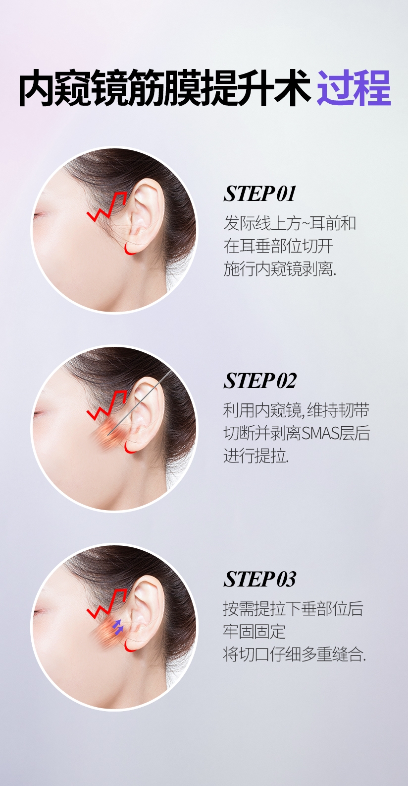 内窥镜筋膜提升术 过程 STEP 01 发际线上方~耳前和 在耳垂部位切开 施行内窥镜剥离. STEP 02 利用内窥镜，维持韧带 切断并剥离SMAS层后 进行提拉. STEP 03 按需提拉下垂部位后 牢固固定 将切口仔细多重缝合.