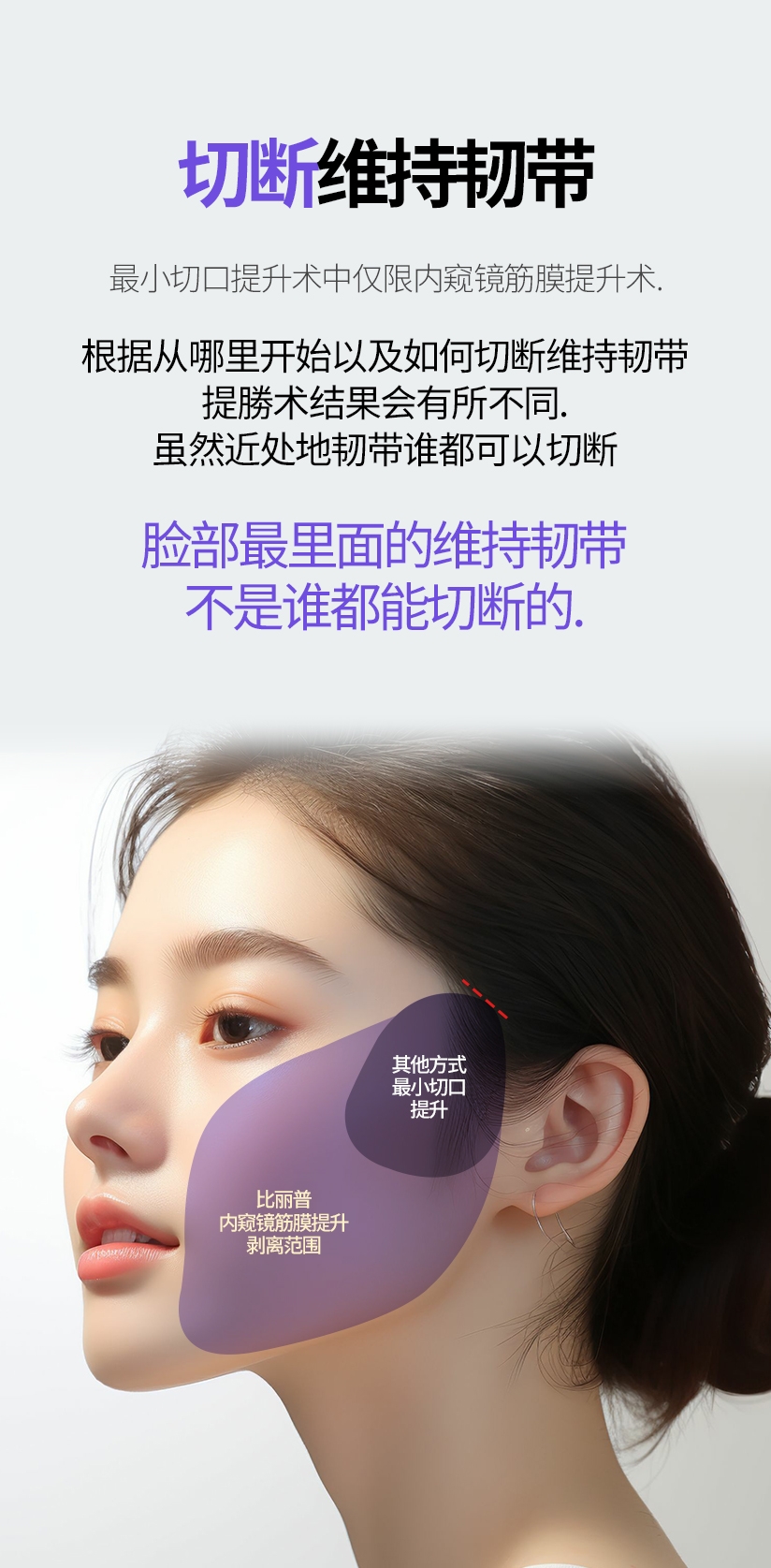 切断维持韧带 最小切口提升术中仅限内窥镜筋膜提升术. 根据从哪里开始以及如何切断维持韧带 提勝术结果会有所不同. 虽然近处地韧带谁都可以切断 脸部最里面的维持韧带 不是谁都能切断的. 比丽普 内窥镜筋膜提升 剥离范围 其他方式 最小切口 提升