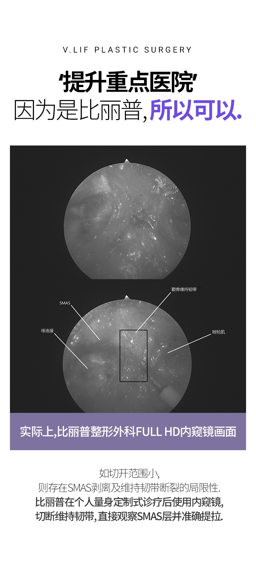 ‘提升重点医院’ 因为是比丽普, 所以可以. 实际上, 比丽普整形外科 FULL HD 内窥镜画面 实际上, 比丽普整形外科 FULL HD 内窥镜画面 如切开范围小, 则存在SMAS剥离及维持韧带断裂的局限性. 比丽普在个人量身定制式诊疗后使用内窥镜, 切断维持韧带, 直接观察SMAS层并准确提拉.