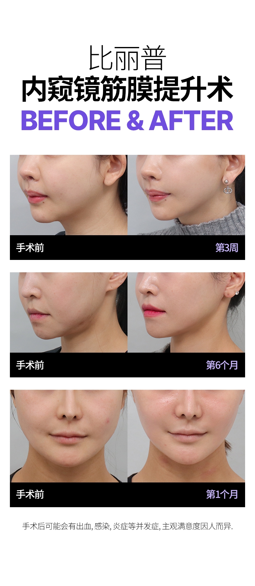 比丽普 内窥镜筋膜提升术 Before & After 手术后可能会有出血, 感染, 炎症等并发症, 主观满意度因人而异.