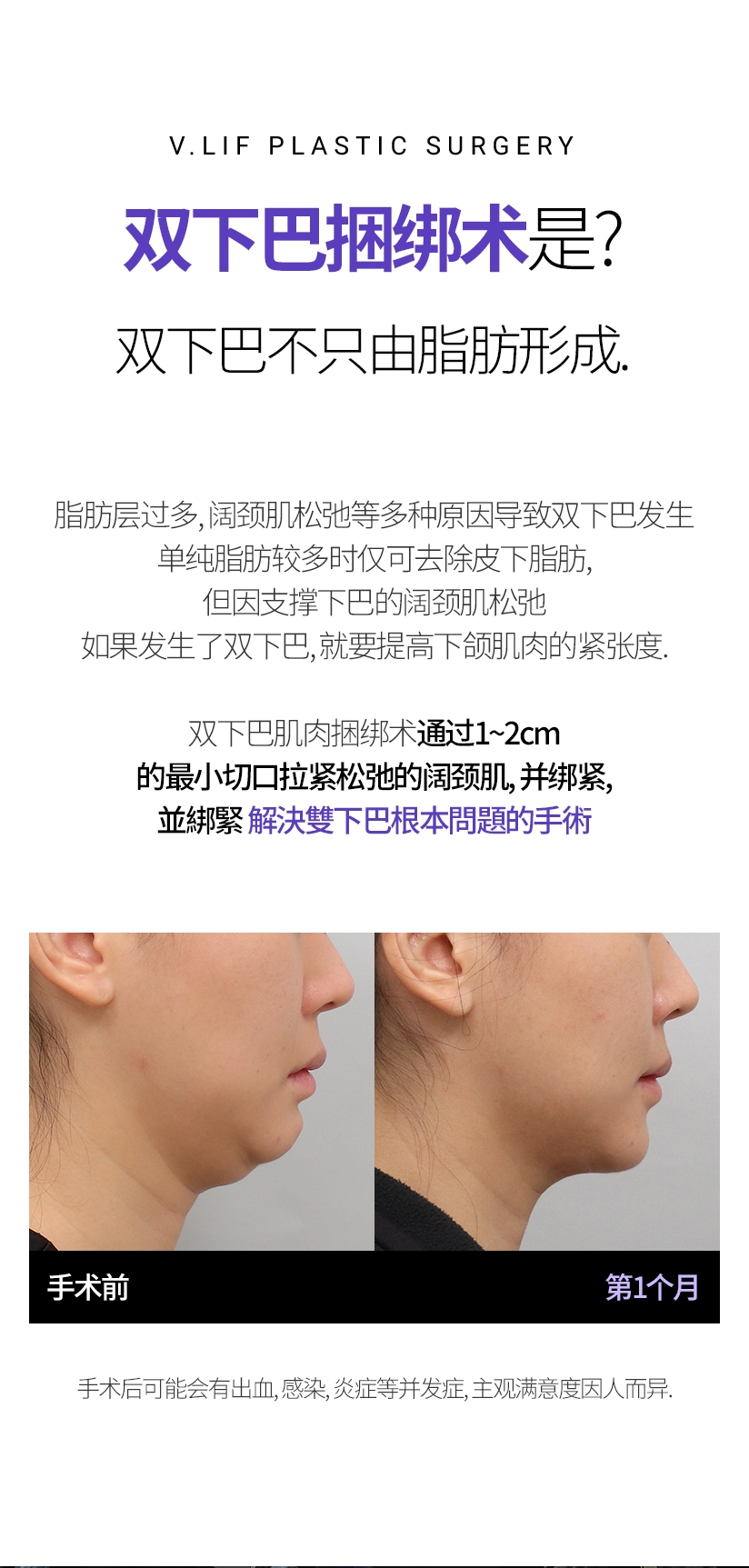 双下巴捆绑术是? 双下巴不只由脂肪形成. 脂肪层过多, 阔颈肌松弛等多种原因导致双下巴发生 单纯脂肪较多时仅可去除皮下脂肪, 但因支撑下巴的阔颈肌松弛 如果发生了双下巴, 就要提高下颌肌肉的紧张度. 双下巴肌肉捆绑术通过1~2cm的最小切口拉紧松弛的阔颈肌, 并绑紧. 解决双下巴根本问题的手术. 手术后可能会有出血, 感染, 炎症等并发症, 主观满意度因人而异.