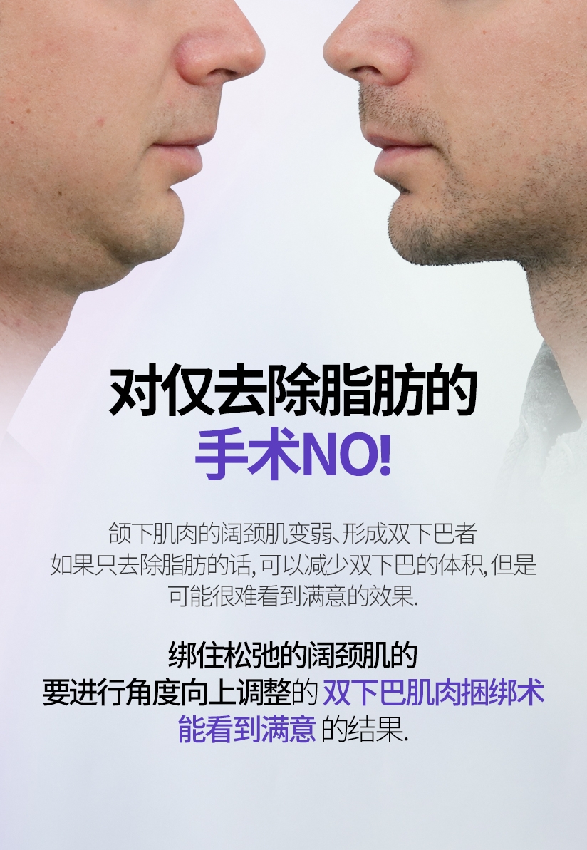 对仅去除脂肪的 手术NO! 颌下肌肉的阔颈肌变弱, 形成双下巴者 如果只去除脂肪的话, 可以减少双下巴的体积, 但是 可能很难看到满意的效果. 绑住松弛的阔颈肌的 要进行角度向上调整的双下巴肌肉捆绑术 能看到满意的结果.