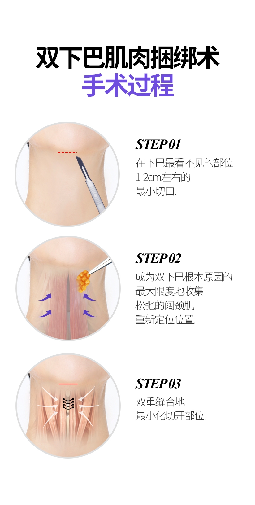双下巴肌肉捆绑术 手术过程 STEP 01 在下巴最看不见的部位 1-2cm左右的 最小切口. STEP 02 成为双下巴根本原因的 最大限度地收集松弛的阔颈肌 重新定位位置. STEP 03 双重缝合地 最小化切开部位.