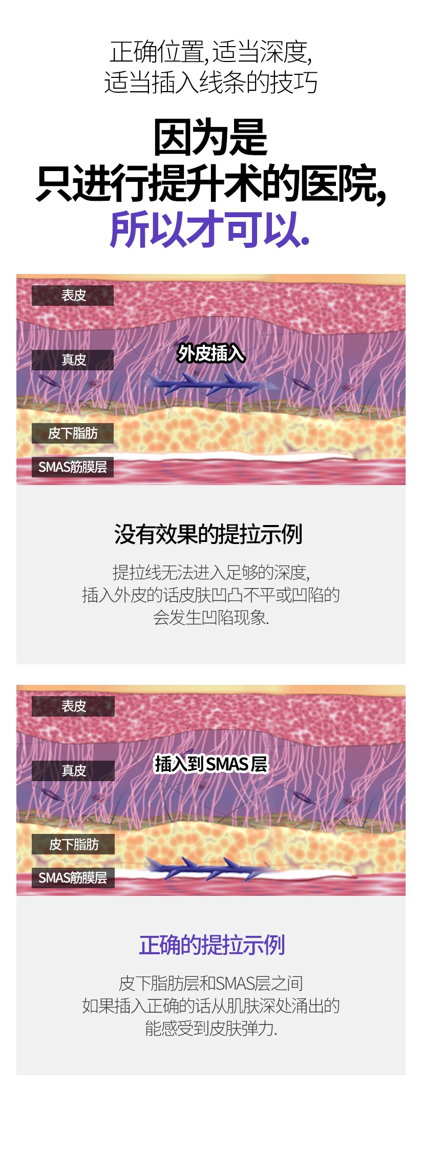 正确位置, 适当深度, 适当插入线条的技巧 因为是只进行提升术的医院, 所以才可以. 没有效果的提拉示例 提拉线无法进入足够的深度, 插入外皮的话 皮肤凹凸不平或凹陷的 会发生凹陷现象. 正确的提拉示例 皮下脂肪层和SMAS层之间 如果插入正确的话 从肌肤深处涌出的 能感受到皮肤弹力. 