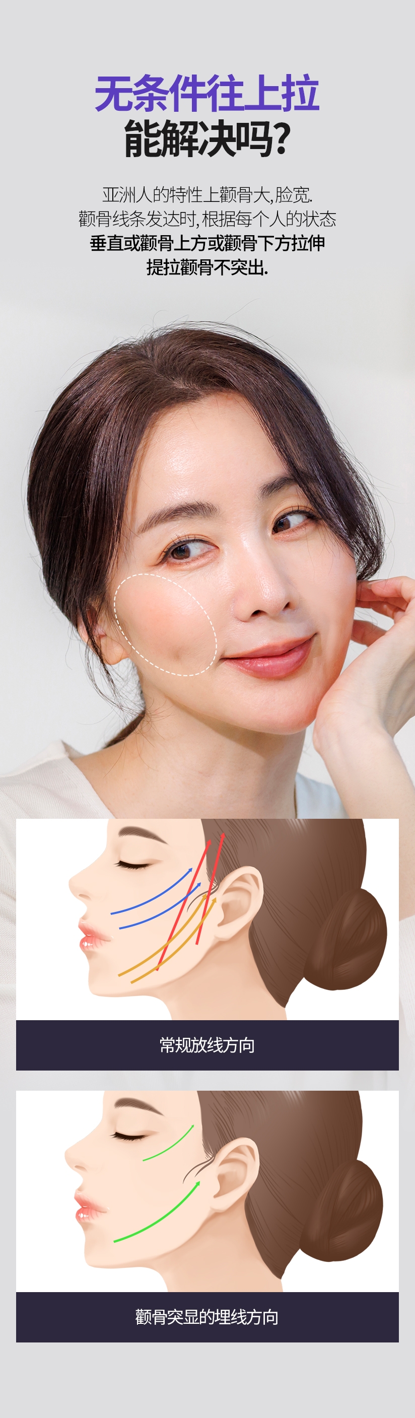 无条件往上拉 能解决吗? 亚洲人的特性上颧骨大, 脸宽. 颧骨线条发达时, 根据每个人的状态 垂直或颧骨上方或颧骨下方拉伸提拉颧骨不突出. 常规放线方向 颧骨突显的埋线方向 