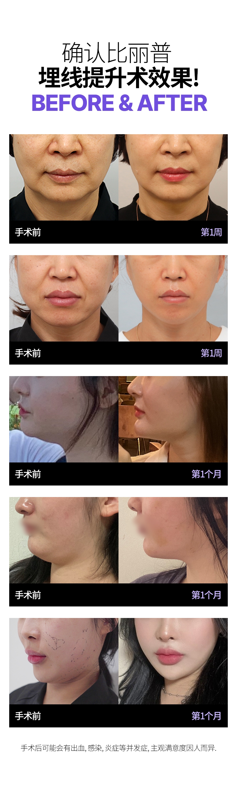 确认比丽普 埋线提升术效果! Before & After 手术后可能会有出血, 感染, 炎症等并发症, 主观满意度因人而异. 